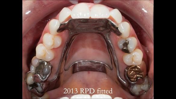 Newsletter 66 Long term case study. Life changing metal based RPD made for Anna