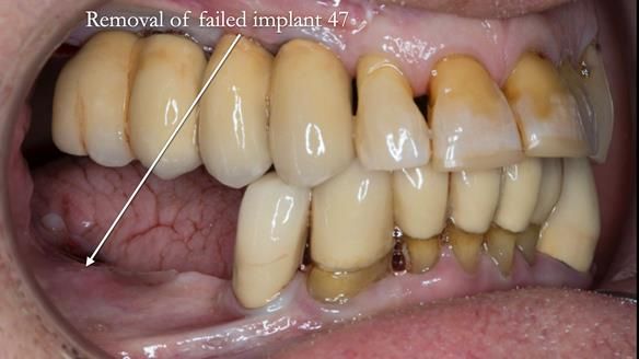Ken – going downhill, first class