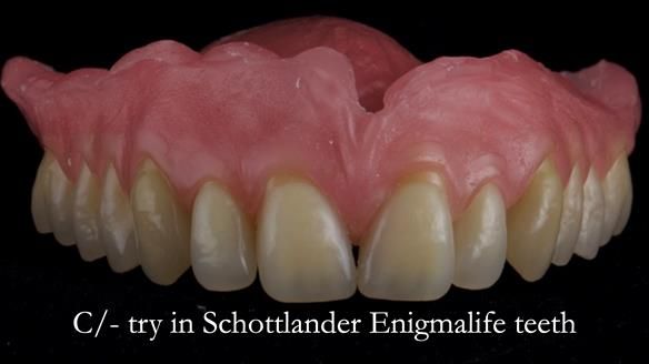 Newsletter 54 case presentation upper complete denture and lower Scandinavian designed hygienic partial denture for David