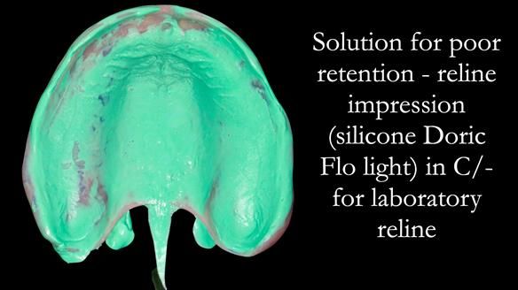 Newsletter 53 showing the making and fitting of ultra life-like dentures for Valena