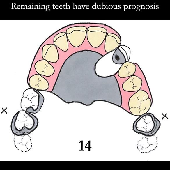 Universal Scandinavian partial denture designs