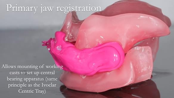 Finlay's Newsletter 59 Ultra hard partial dentures made for Gill