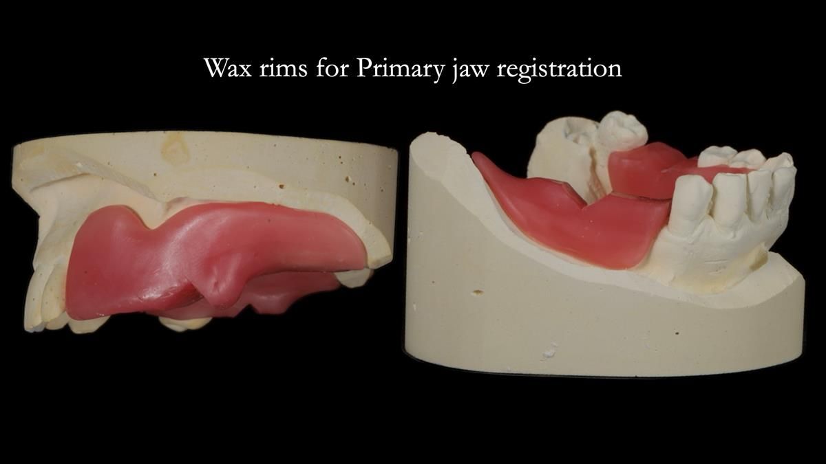 Newsletter 89 – Simon: A Challenging Kennedy Class II Division 1 Upper CoCr Partial Denture with a High Smile Line