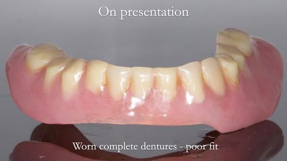 Newsletter 57 showcases the making and fitting process of implant-supported complete dentures for Alisdair