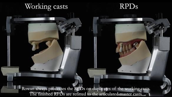 Finlay's Newsletter 59 Ultra hard partial dentures made for Gill