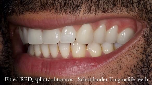 Upper metal base partial denture/occlusal stabilisation splint/obturator - full protocol