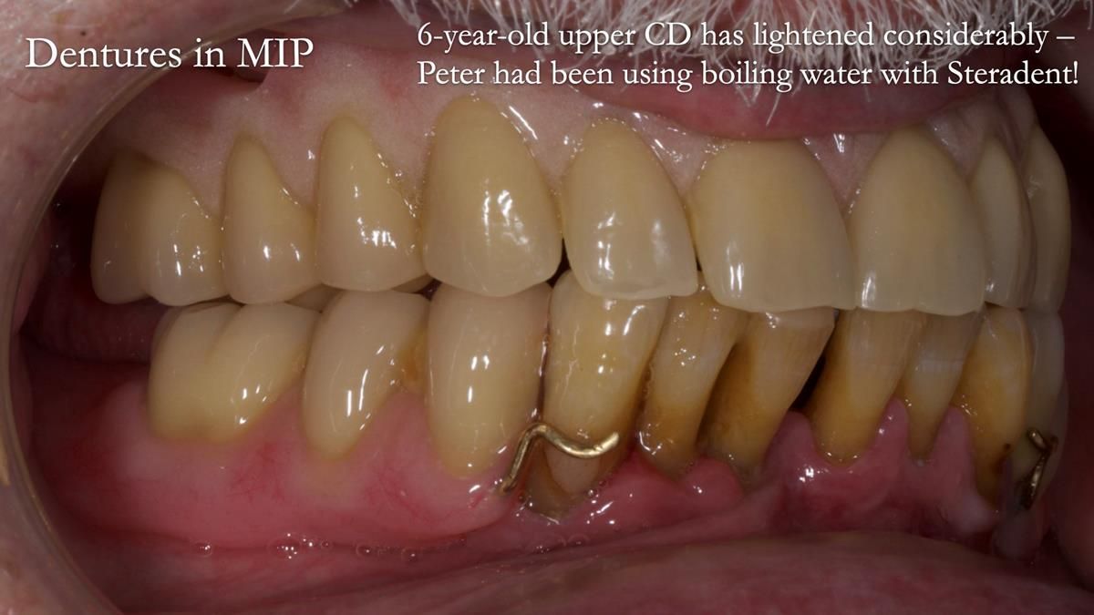 Newsletter 87 – Father Peter: A Partial Denture that needed Minor Miracle