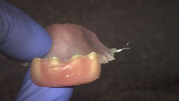 Figure 36 Wax placed on labial surface of the teeth prior to Visco-gel reline. This prevents the viscogel from running into the interdental embrasures helping with quicker clean up