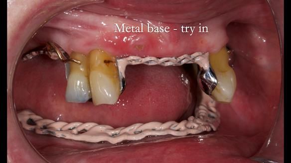 Finlay's Newsletter 59 Ultra hard partial dentures made for Gill