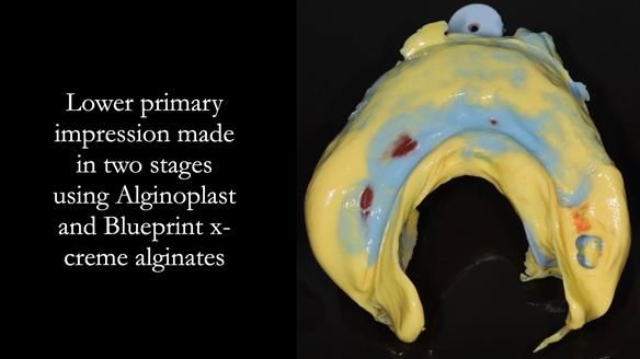 Finlay's Newsletter 59 Ultra hard partial dentures made for Gill