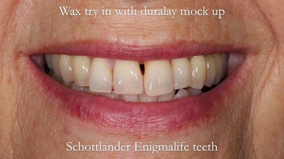 Newsletter 56 showing the making and fitting of a bilateral free end saddle upper removable partial denture (RPD) for patient with pemphigus