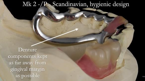 Newsletter 54 case presentation upper complete denture and lower Scandinavian designed hygienic partial denture for David
