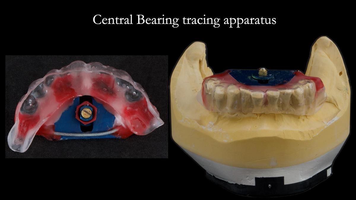 Newsletter 87 – Father Peter: A Partial Denture that needed Minor Miracle