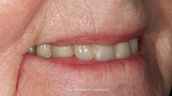 Newsletter 82 Mary - A complete upper and a one-tooth gasket denture