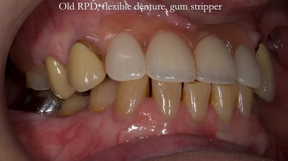 Newsletter 81 - Pam’s Story — how a partial denture changed her life (+ live walkthrough this Thursday)