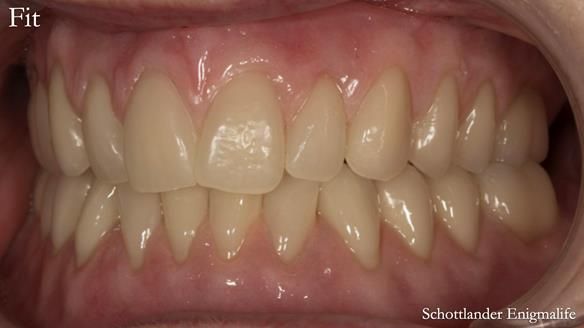 Newsletter 75: Marion’s case - Step-by-step complete denture workflow