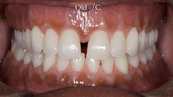 Newsletter 53 showing the making and fitting of ultra life-like dentures for Valena