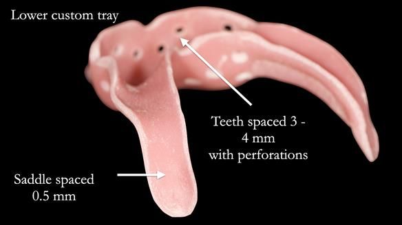 Newsletter 52 Managing Jo’s failing dentition with extractions and Mk 1/Mk 2 complete upper dentures and lower partial dentures FULL PROTOCOL