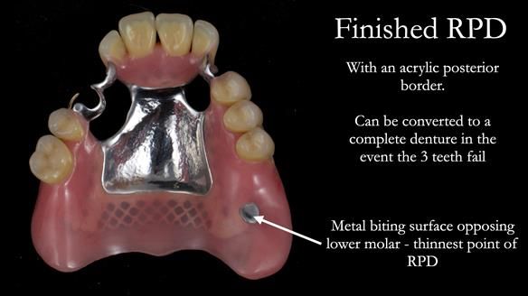 Finlay's Newsletter 59 Ultra hard partial dentures made for Gill