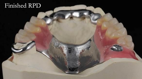 Finlay's Newsletter 60 Sylvia's upper Kennedy Class 2 Mod 1 metal based upper RPD