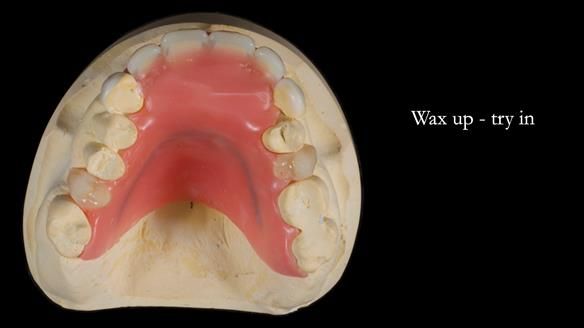 Newsletter 81 - Pam’s Story — how a partial denture changed her life (+ live walkthrough this Thursday)