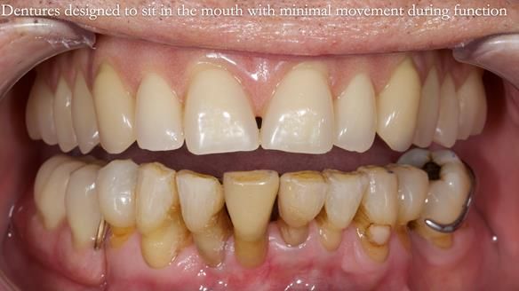 Newsletter 54 case presentation upper complete denture and lower Scandinavian designed hygienic partial denture for David