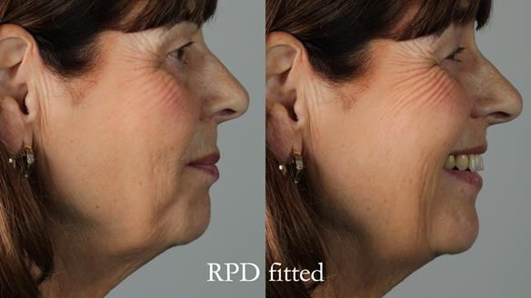 Newsletter 56 showing the making and fitting of a bilateral free end saddle upper removable partial denture (RPD) for patient with pemphigus