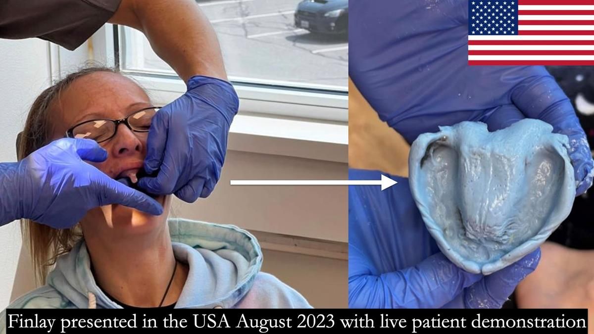 Finlay's Newsletter 59 Ultra hard partial dentures made for Gill