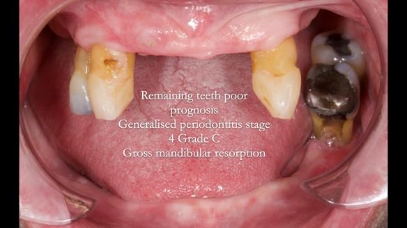 Finlay's Newsletter 59 Ultra hard partial dentures made for Gill
