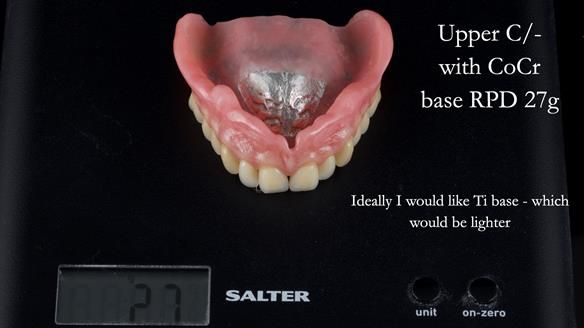 Newsletter 54 case presentation upper complete denture and lower Scandinavian designed hygienic partial denture for David