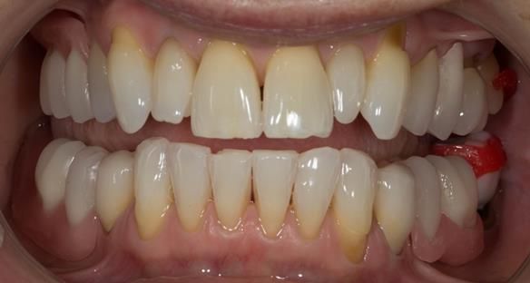 Figure 65 Teeth try in on pattern resin bases in the mouth. These help to confirm the accuracy of the working casts and the amount of metal work which will be visible in the final dentures