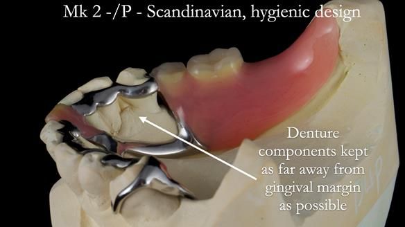 Newsletter 54 case presentation upper complete denture and lower Scandinavian designed hygienic partial denture for David