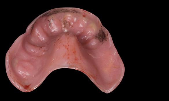 Figure 36 A pencil mark shows the areas that push through - often this is the labial flange. This is adjusted with a tungsten carbide bur