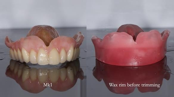 Newsletter 77: Jeremy’s case – immediate complete upper denture