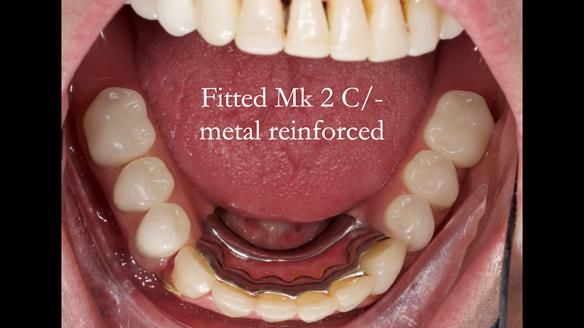 Newsletter 52 Managing Jo’s failing dentition with extractions and Mk 1/Mk 2 complete upper dentures and lower partial dentures FULL PROTOCOL