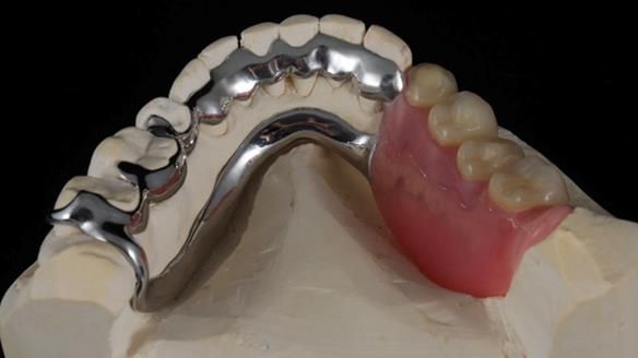 Finlay's Newsletter 61 provision of a lower unilateral free end saddle metal based partial denture for Joyce