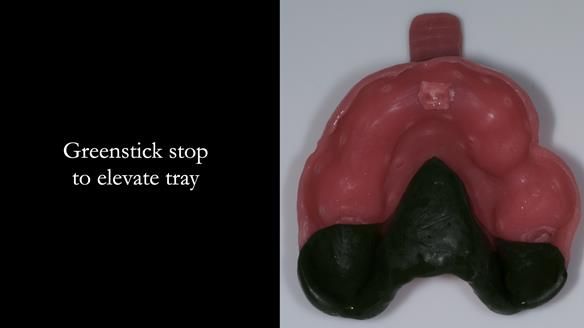 Newsletter 77: Jeremy’s case – immediate complete upper denture