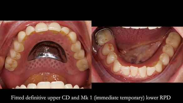 Newsletter 82 Mary - A complete upper and a one-tooth gasket denture