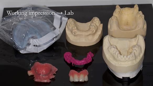 Newsletter 81 - Pam’s Story — how a partial denture changed her life (+ live walkthrough this Thursday)