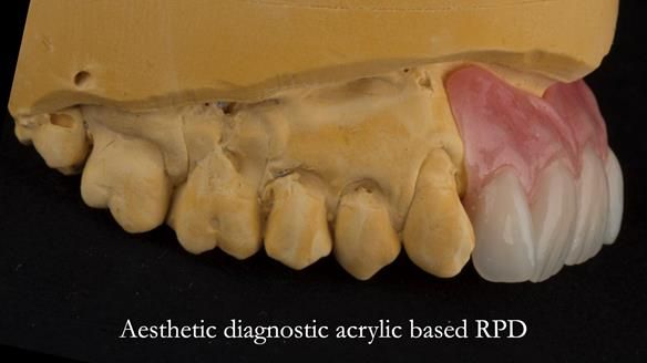 Newsletter 66 Long term case study. Life changing metal based RPD made for Anna