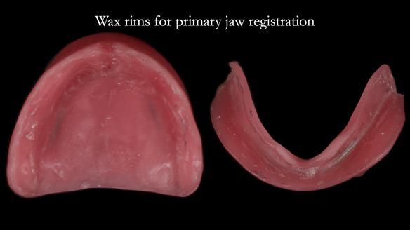 Newsletter 83: Sheila’s Complete Denture Success