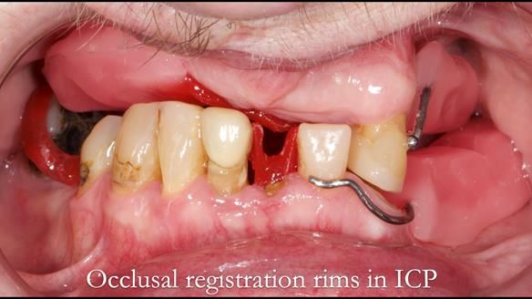 Newsletter 55 Provision of metal based partial dentures for Zephyrine with a repaired cleft lip and palate