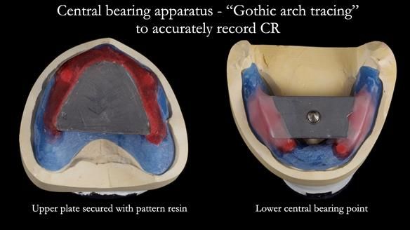 Newsletter 57 showcases the making and fitting process of implant-supported complete dentures for Alisdair