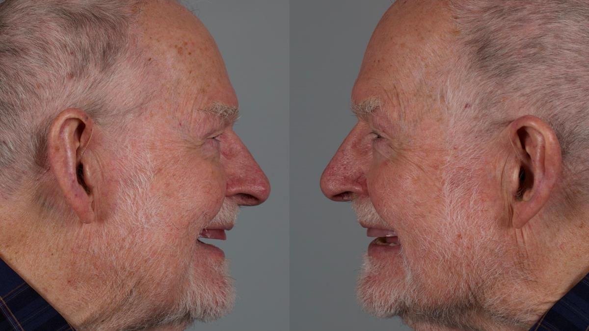 Newsletter 87 – Father Peter: A Partial Denture that needed Minor Miracle
