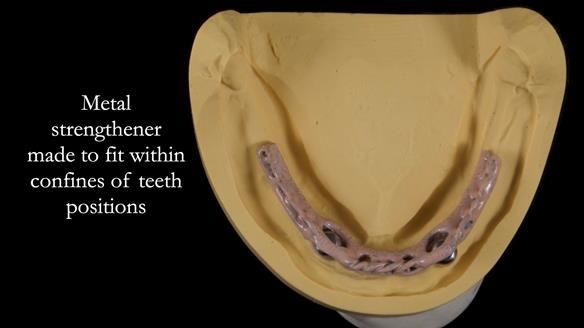 Newsletter 57 showcases the making and fitting process of implant-supported complete dentures for Alisdair