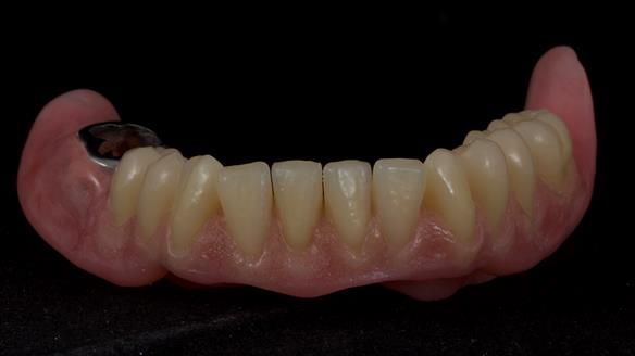 Newsletter 82 Mary - A complete upper and a one-tooth gasket denture