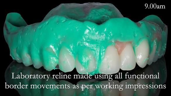 Newsletter 52 Managing Jo’s failing dentition with extractions and Mk 1/Mk 2 complete upper dentures and lower partial dentures FULL PROTOCOL