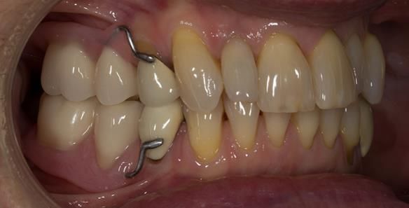 Figure 37 Immediate dentures fitting in ICP. Schottlander Enigmalife teeth.