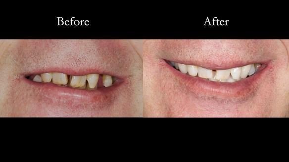 Newsletter 86 Peter the Architect — precision removable partial dentures case study