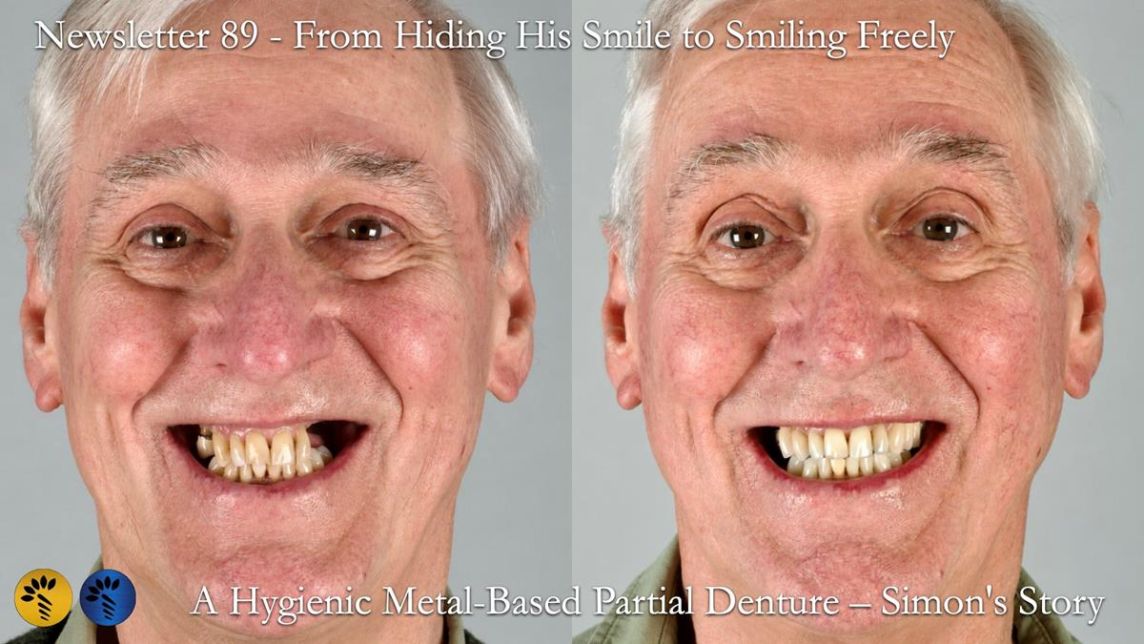Newsletter 89 – Simon: A Challenging Kennedy Class II Division 1 Upper CoCr Partial Denture with a High Smile Line